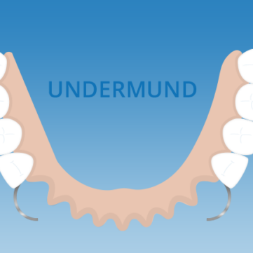 Protese i undermund